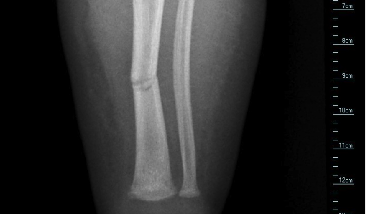 FracturedTibia.png