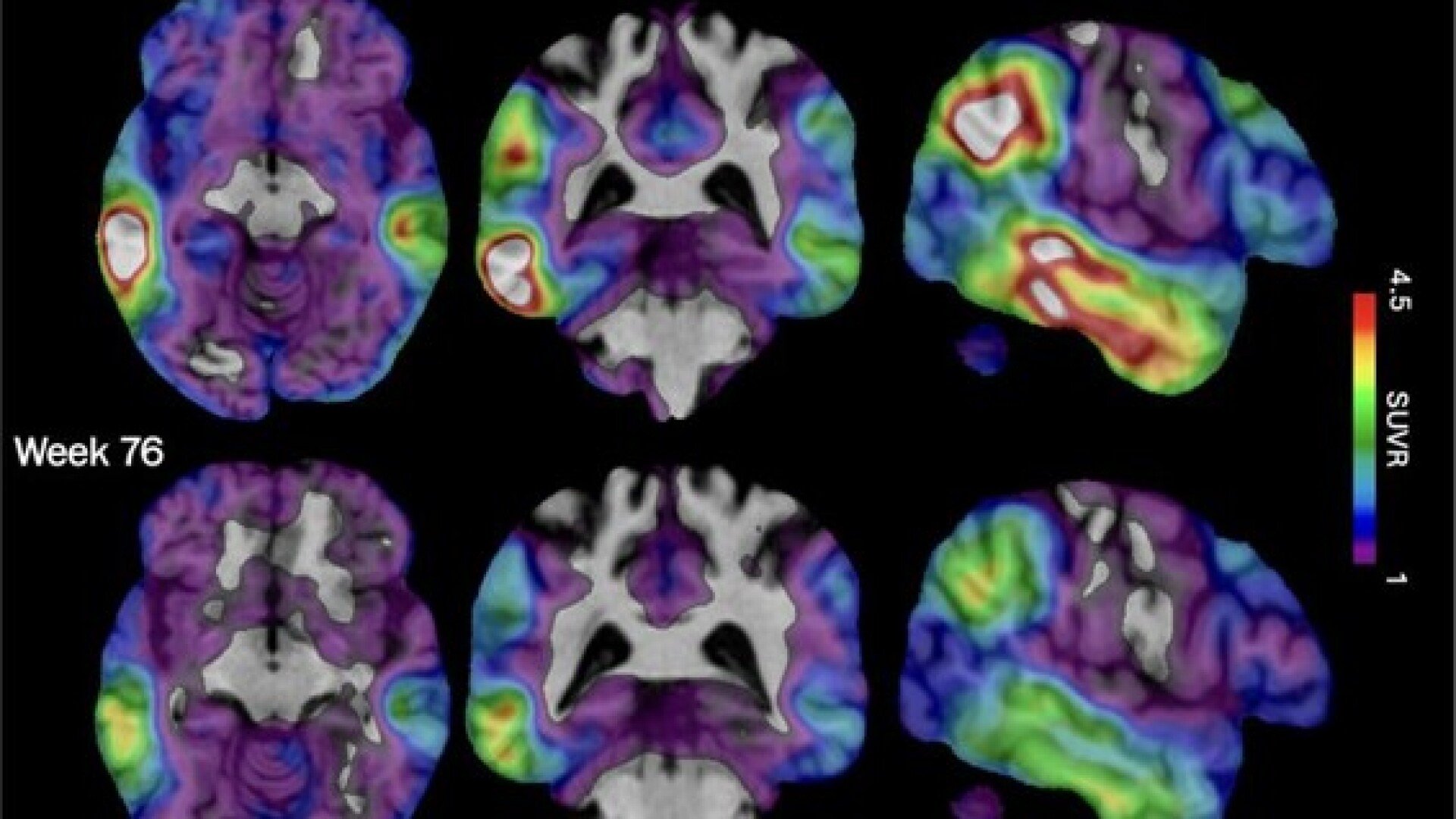 Alzheimers New Experimental Drugs